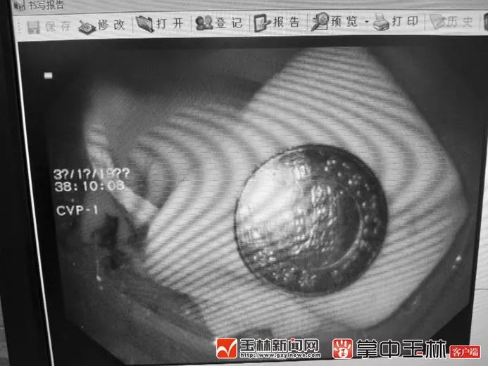 五岁男孩误食硬币想呕怎么办,男童误食硬币