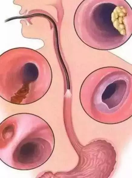 趁热吃东西的危害是什么,趁热吃是怎样毁掉你的食道的