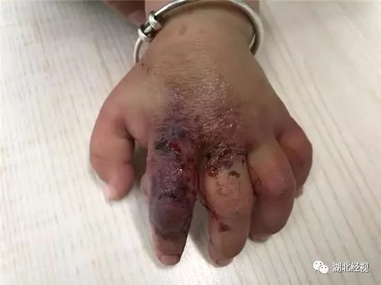 10个月宝宝手指上长了个类似水泡,10个月宝宝手突然肿了