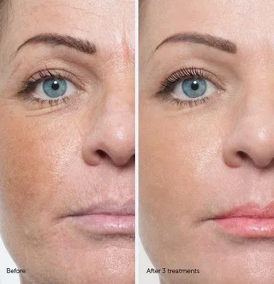 脚底注射肉毒毒素多少钱,脚底注射肉毒素的危害