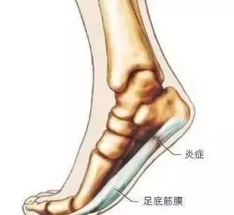 脚后底板疼是怎么回事,脚底板疼是怎么回事小学生