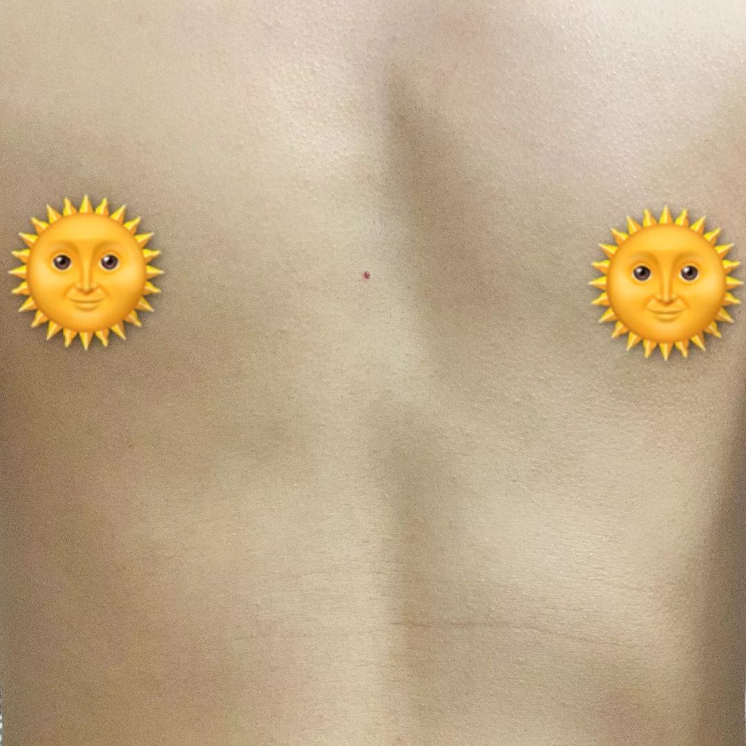 脸上有痣是不是代表有福,脸上长痣的前提是什么