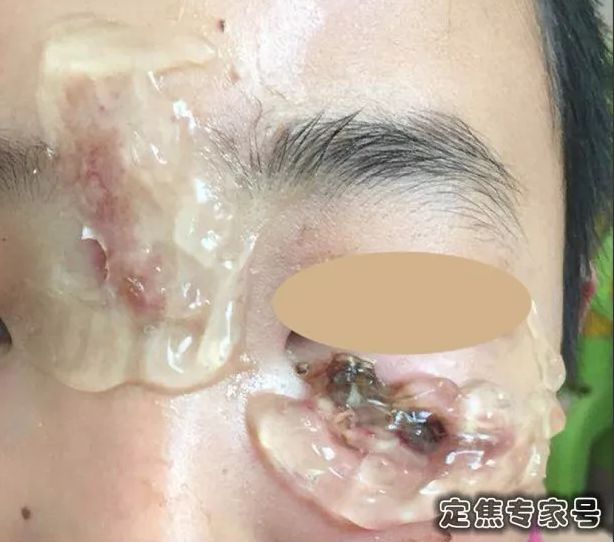 抹芦荟胶有多大的伤害,芦荟胶不是万能的小心毁了你的脸