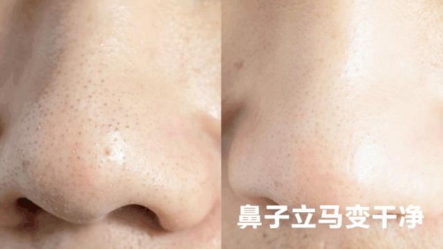 超级黑头正确处理方法,黑头别膨胀3招把你刷光光