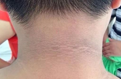 女孩脖子黑且洗不干净怎么回事,脖子一圈黑黑的跟没洗干净似的