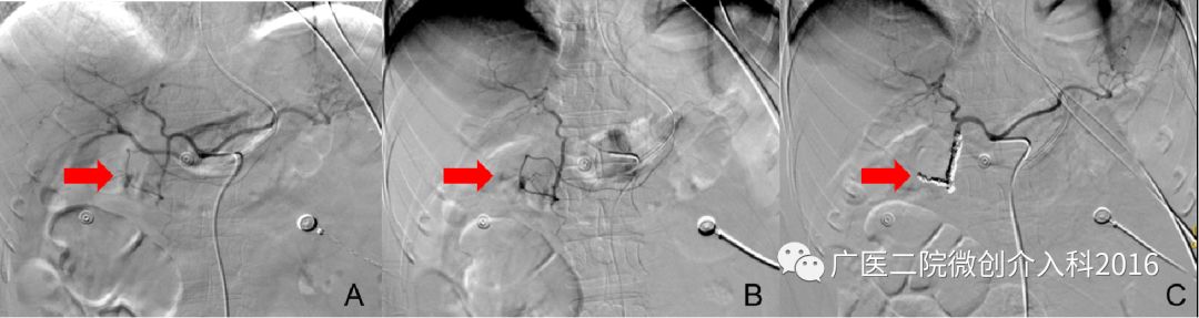 出现了吐血吃什么药,吐血又便血是什么病的征兆