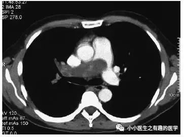 肺动脉分支充盈欠佳是肺栓塞吗,肺动脉缺损不可逆
