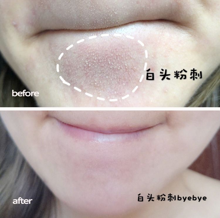 脸上搓出3斤泥!难怪又黄又暗又黑头!10秒给脸蛋“剥壳”,厉害