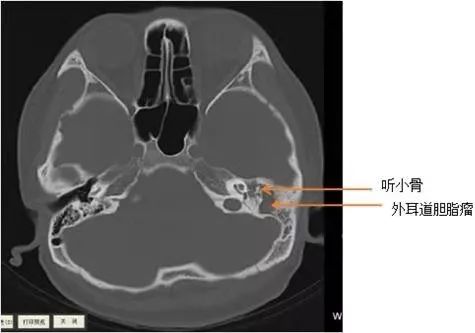 「提醒」20多岁姑娘耳屎总也掏不尽，结果在耳朵里发现了这东西...