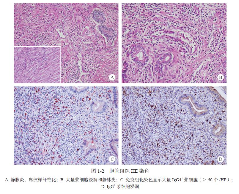 igg4疾病胆管炎会引起ca199升高吗,igg4相关性胰腺胆管炎
