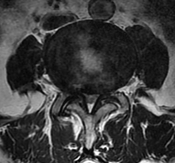 一分钟带你了解腰椎狭窄,椎管狭窄症知识大全