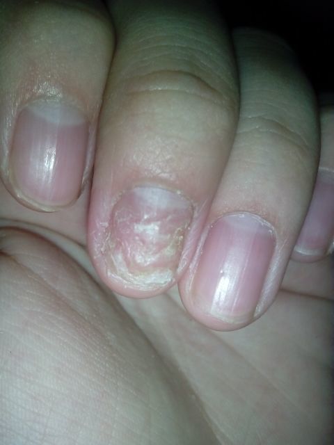 梁医生讲灰指甲怎么治,你的灰指甲是怎么治好的