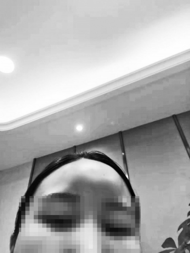 微整形注射玻尿酸失败案例,女生注射药剂整容失败脸肿