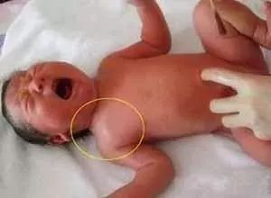 新生小孩锁骨骨折怎么办？