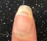 灰指甲致癌吗,灰指甲美甲的禁忌