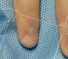 灰指甲致癌吗,灰指甲美甲的禁忌