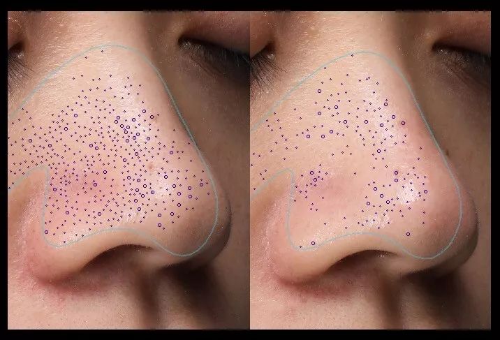 用黑头仪吸完黑头黑头还会再长吗,黑头别膨胀3招把你刷光光