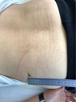 脊柱注射治疗腰突,专治腰突不打针不手术