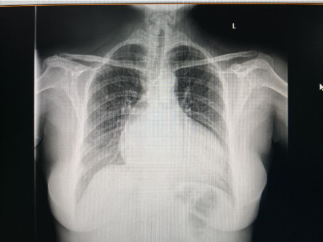 缺血性心脏病吃哪些中成药,心肌缺血合并心衰吃什么恢复得快