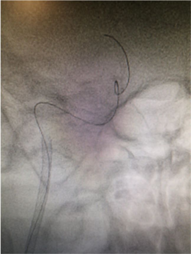 颈内动脉闭塞先进治疗,颈内动脉闭塞开通术病例讨论