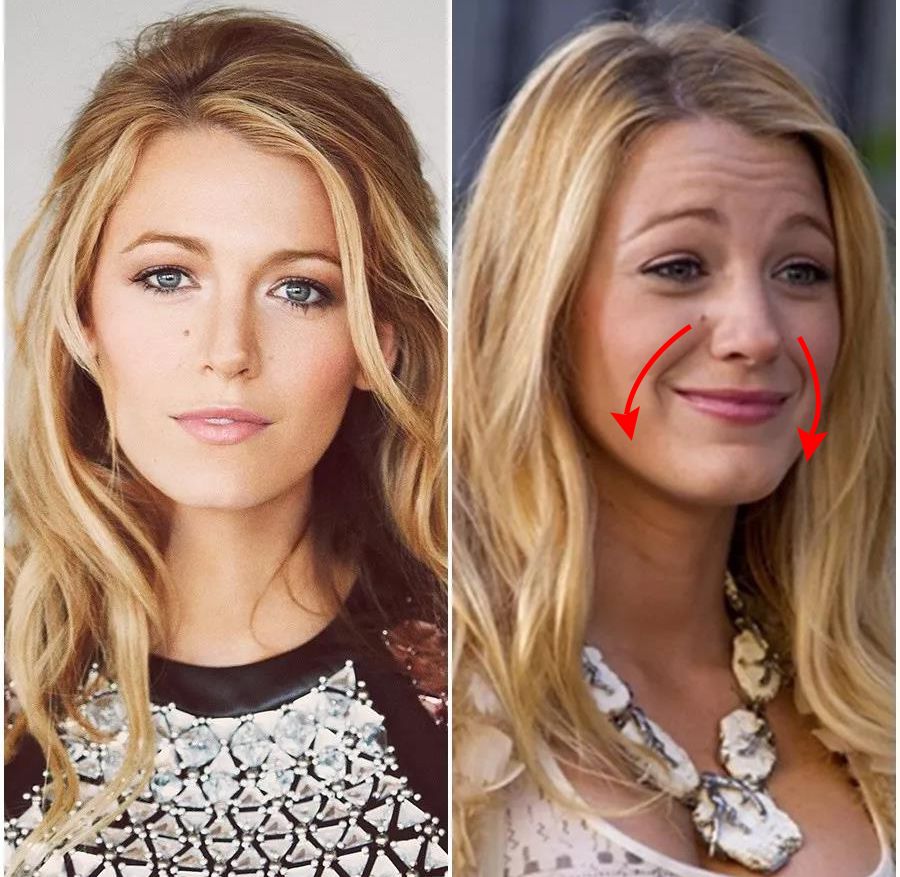 眉间纹和法令纹除皱针能去掉吗,嘴角纹法令纹抬头纹国货推荐