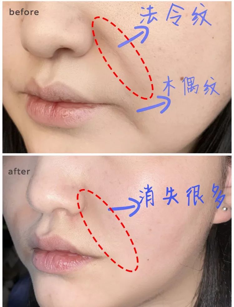 眉间纹和法令纹除皱针能去掉吗,嘴角纹法令纹抬头纹国货推荐