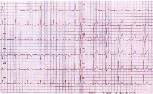 胸疼还有一个坑,胸痛症状缓解可能是陷阱