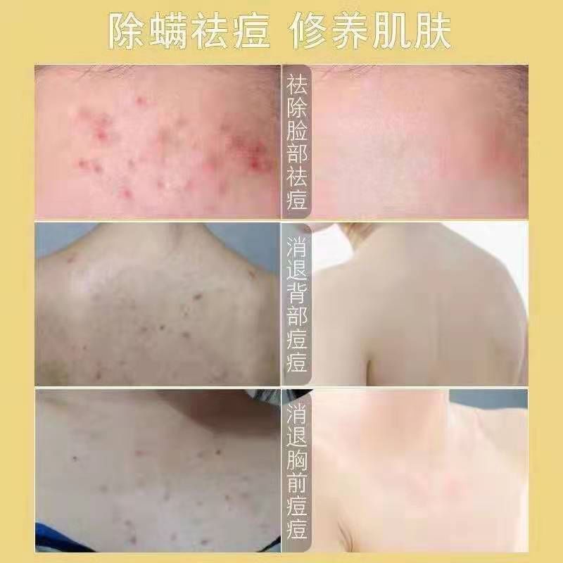 可美金箔祛痘螨虫皂,除螨皂能祛螨虫吗