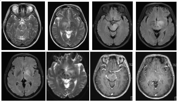 急性脂肪栓塞、神经白塞病、NMOSD极后区综合征丨3分钟读片·第11期