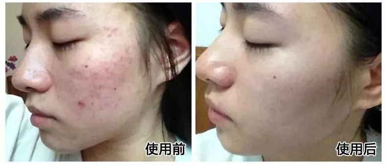 痘痘闭口里面有油脂,鼻子上的痘痘是青春痘还是粉刺