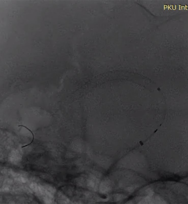 物华天宝·第7期｜脑部长型巨大夹层动脉瘤的4个密网支架桥接治疗复查治愈（附复查CTA结果）