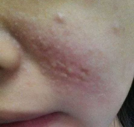 隐形虫叮咬后多久出现征兆,隐翅虫叮咬会死人吗