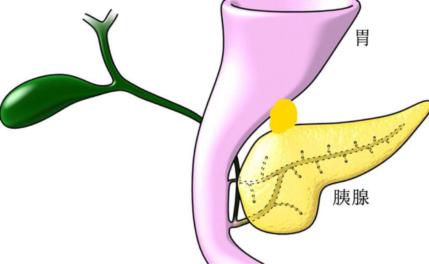 罕见，胰腺长在胃上！一先天性高胰岛素血症婴儿在上海获救