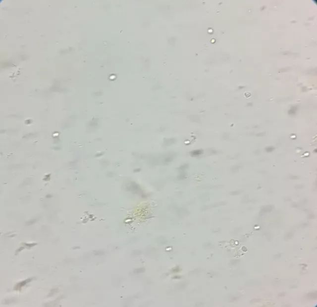 儿童大便里有霉菌的治疗,小孩粪便检查出霉菌