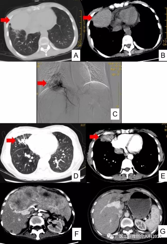 精准介入治疗效果好吗,精准免疫治疗最新消息