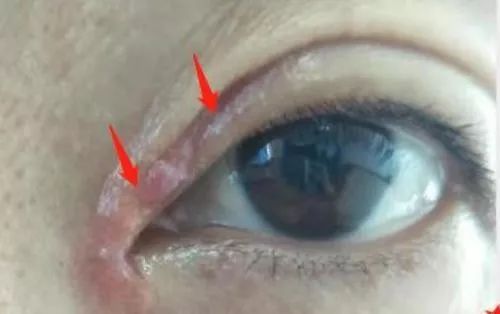 女子整形割双眼皮,女子整容后惨不忍睹