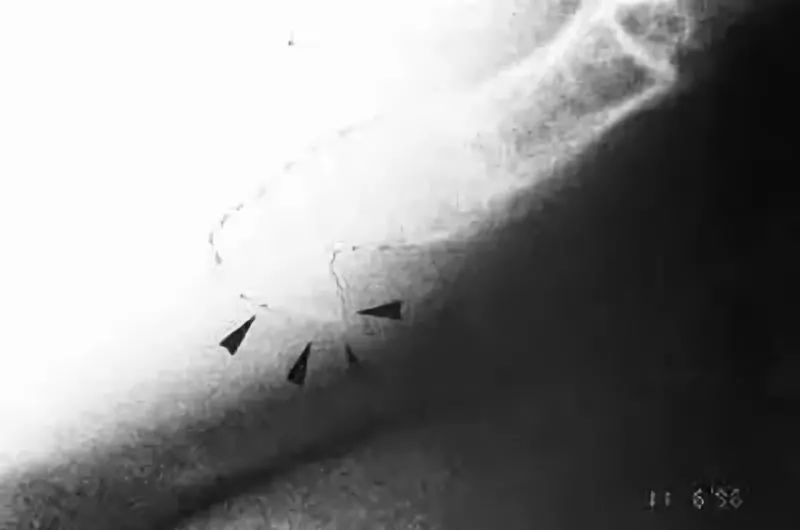 一文读懂十种腹痛,一文读懂骨关节炎