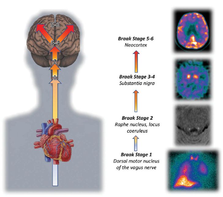 快速眼动期睡眠行为障碍中医治疗,快速眼动睡眠障碍症能活多久