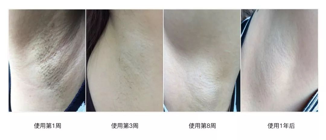 不要错过脱毛好季节,别再错过脱毛最佳季节