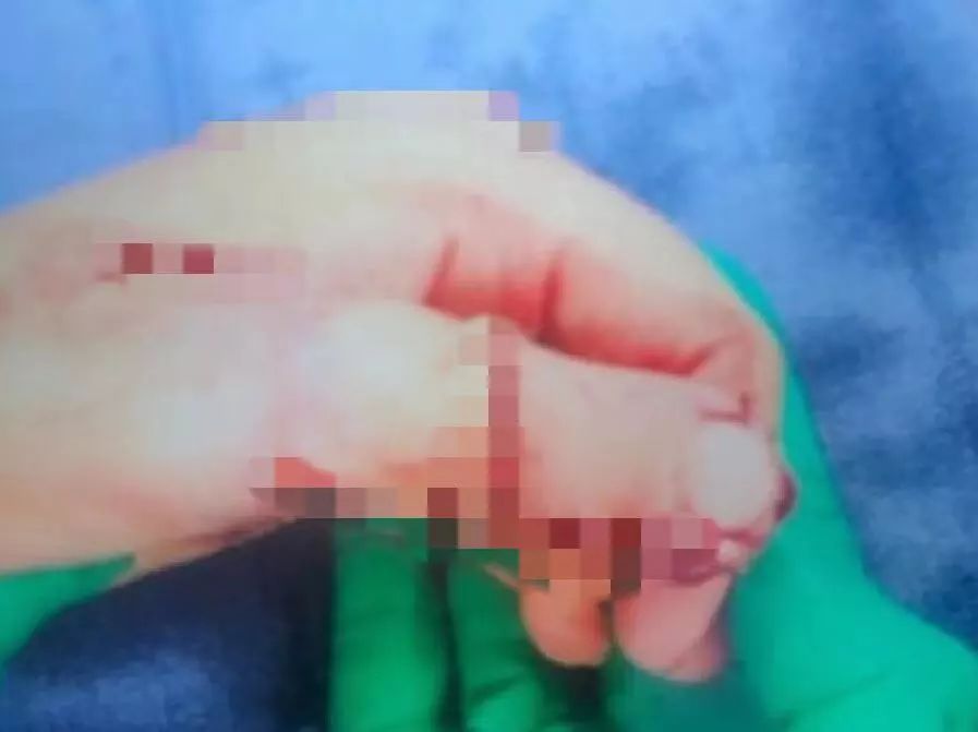 她扭伤手指，却被医生匪夷所思的操作治到截肢，还把拇指变成了脚趾...