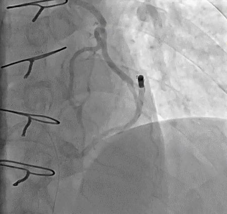 冠脉造影技术成熟不,跟我学技术分析从入门到精通