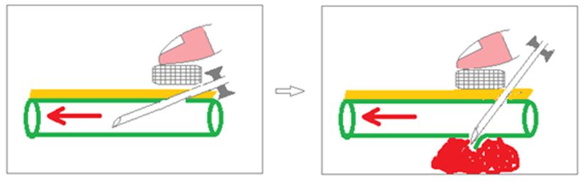 血透动静脉内瘘手术三种术式图解,血透室动静脉内瘘穿刺及护理