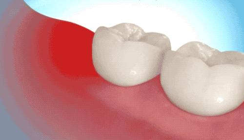 拔智齿的全过程科普,拔智齿细致操作过程