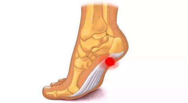 如何锻炼足底筋膜,改善足底筋膜炎跑步动作