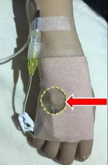 留置针u型敷贴正确撕法,留置针正确固定图片ppt