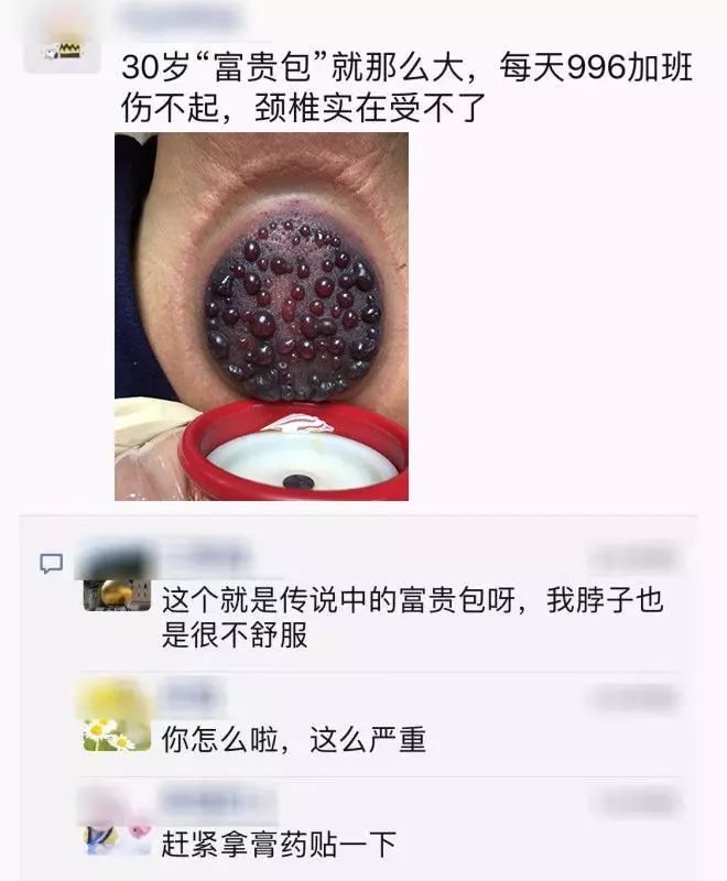 富贵包导致脖子筋痛用什么治疗,富贵包消除的最佳神器