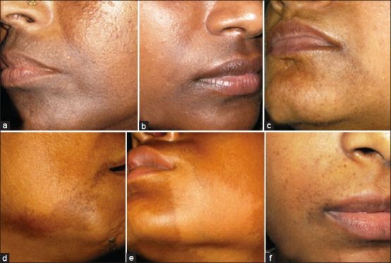 嘴角变黑了会自己好吗,嘴角黑点忽然变黑变大