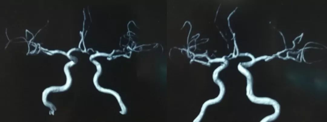 中医治疗脑夹层动脉瘤,3d演示夹层动脉瘤支架治疗