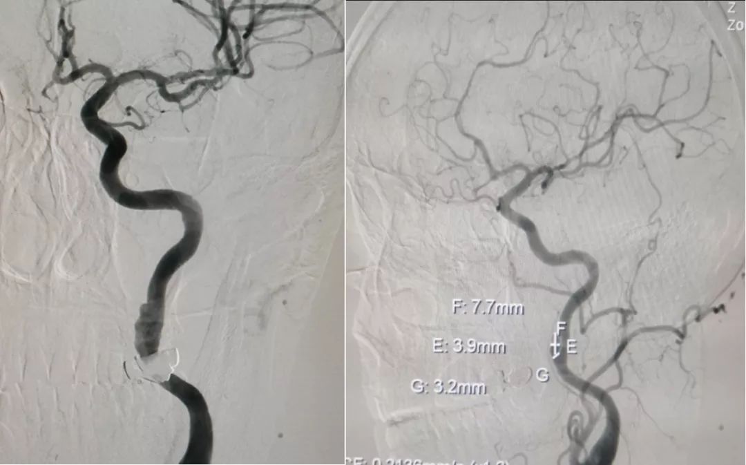 中医治疗脑夹层动脉瘤,3d演示夹层动脉瘤支架治疗