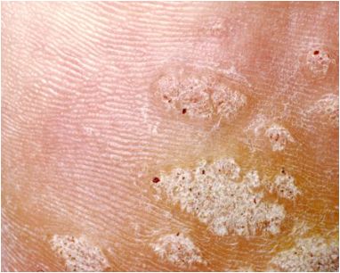 鸡眼和疣如何区别,掌跖疣是不是鸡眼